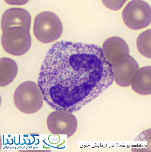 Toxic granulation در آزمایش خون